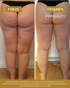 Firmeauty™ Kit Reductor de Celulitis