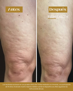 Firmeauty™ Kit Masajeador Scraping para Celulitis y Lipedema