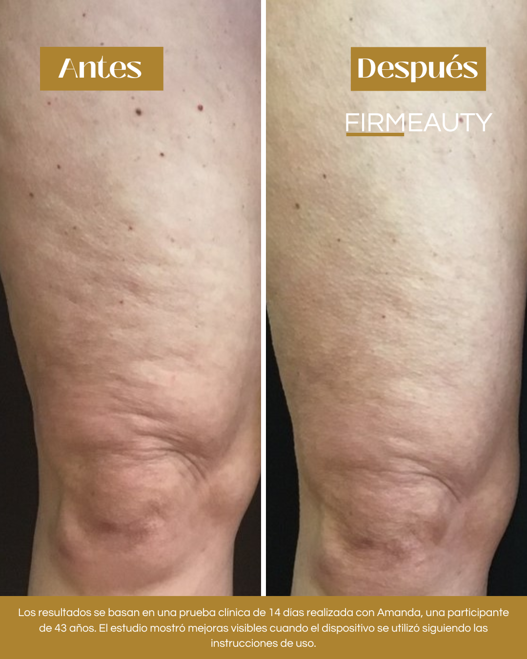 Firmeauty™ Kit Masajeador Scraping para Celulitis y Lipedema