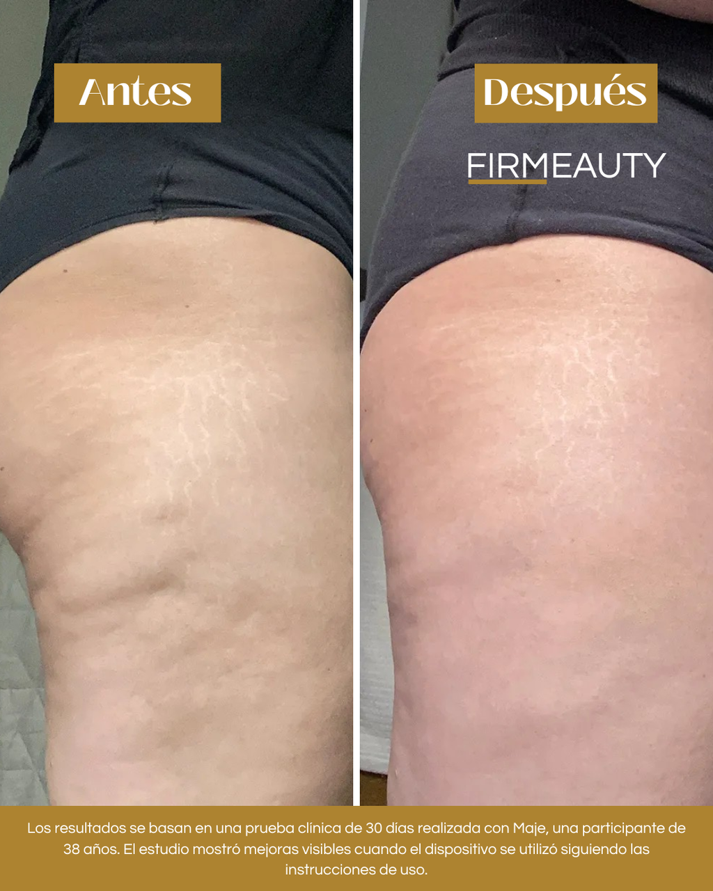 Firmeauty™ Kit Masajeador Scraping para Celulitis y Lipedema