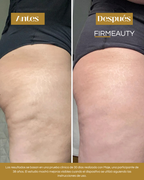 Firmeauty™ Kit Masajeador Scraping para Celulitis y Lipedema
