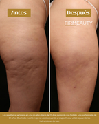 Firmeauty™ Kit Masajeador Scraping para Celulitis y Lipedema