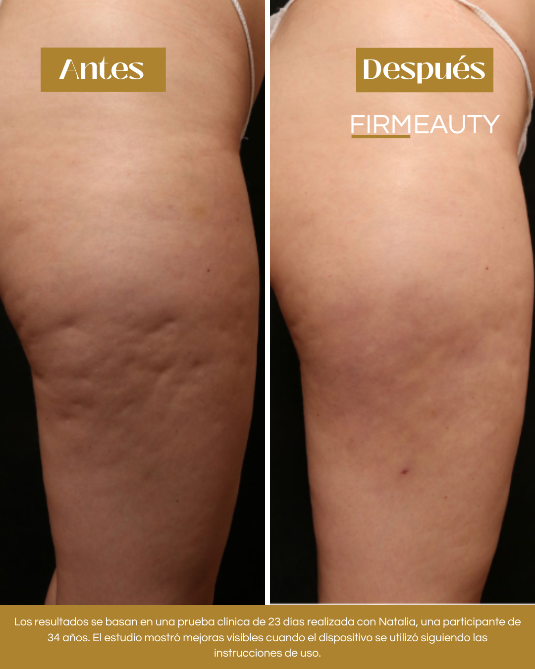 Firmeauty™ Kit Masajeador Scraping para Celulitis y Lipedema