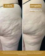 Firmeauty™ Kit Masajeador Scraping para Celulitis y Lipedema