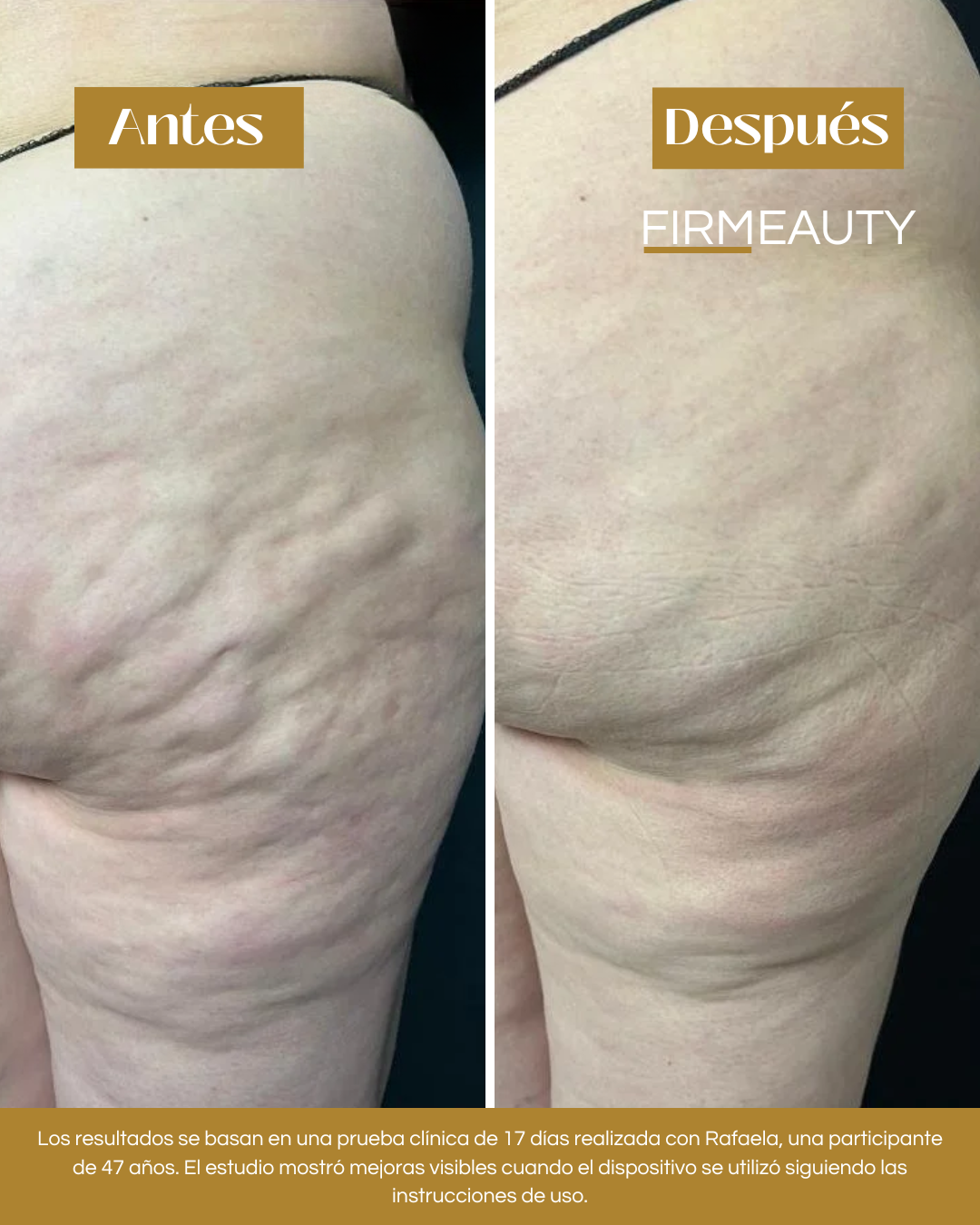 Firmeauty™ Kit Masajeador Scraping para Celulitis y Lipedema