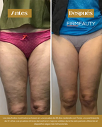Firmeauty™ Kit Reductor de Celulitis